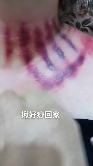 紫悦985揪痧图片